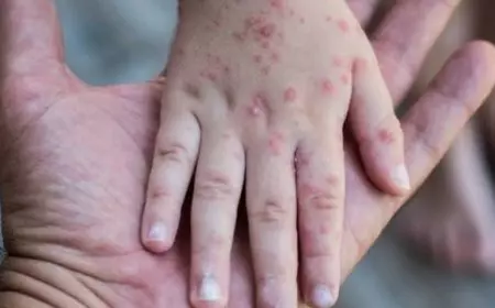 17 Suspek Campak Terdeteksi dalam Dua Bulan Terakhir, Dinkes Kota Probolinggo Minta Warga Tak Abaikan Gejala